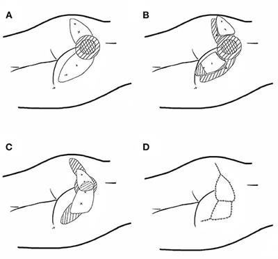 Application of the Jigsaw Puzzle Flap Based on Freestyle Perforators to Repair Large and Deep Ulcers on the Buttocks